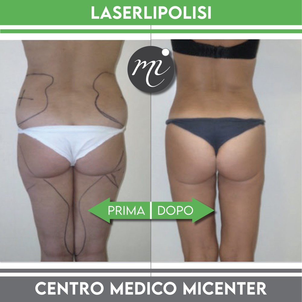 Prima e dopo laserlipolisi