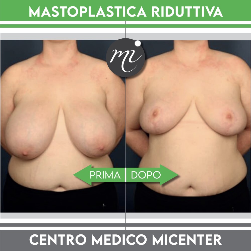 Prima e dopo mastoplastica riduttiva