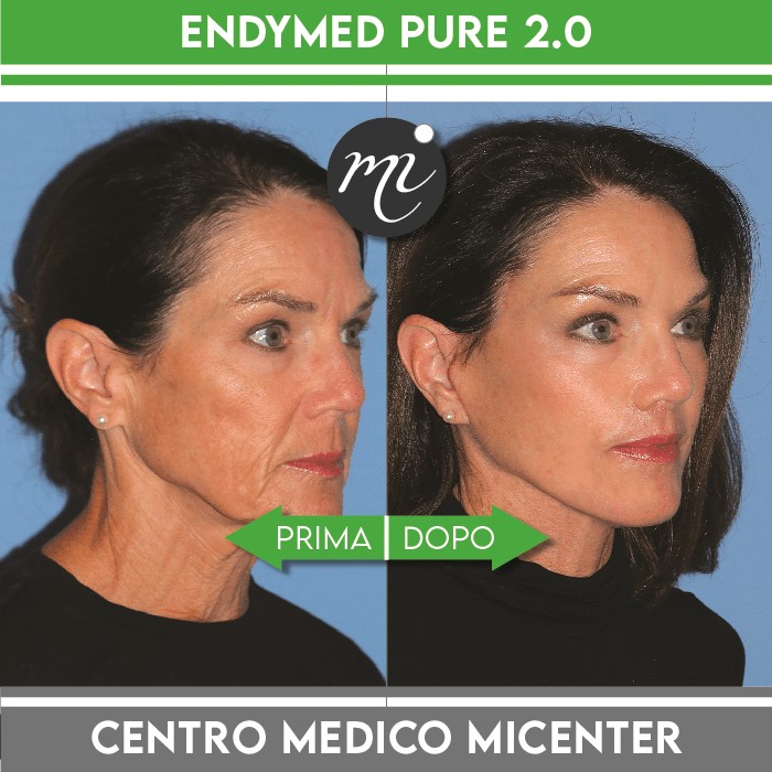 Risultati endymed micenter 1