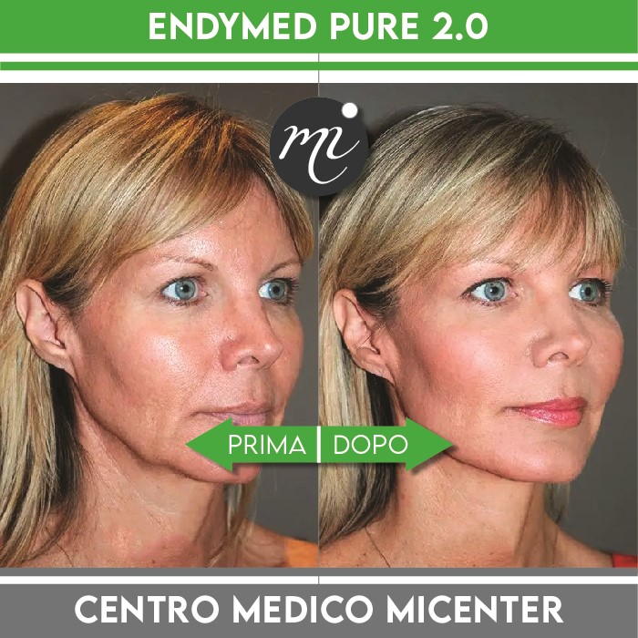 Risultati endymed micenter 2